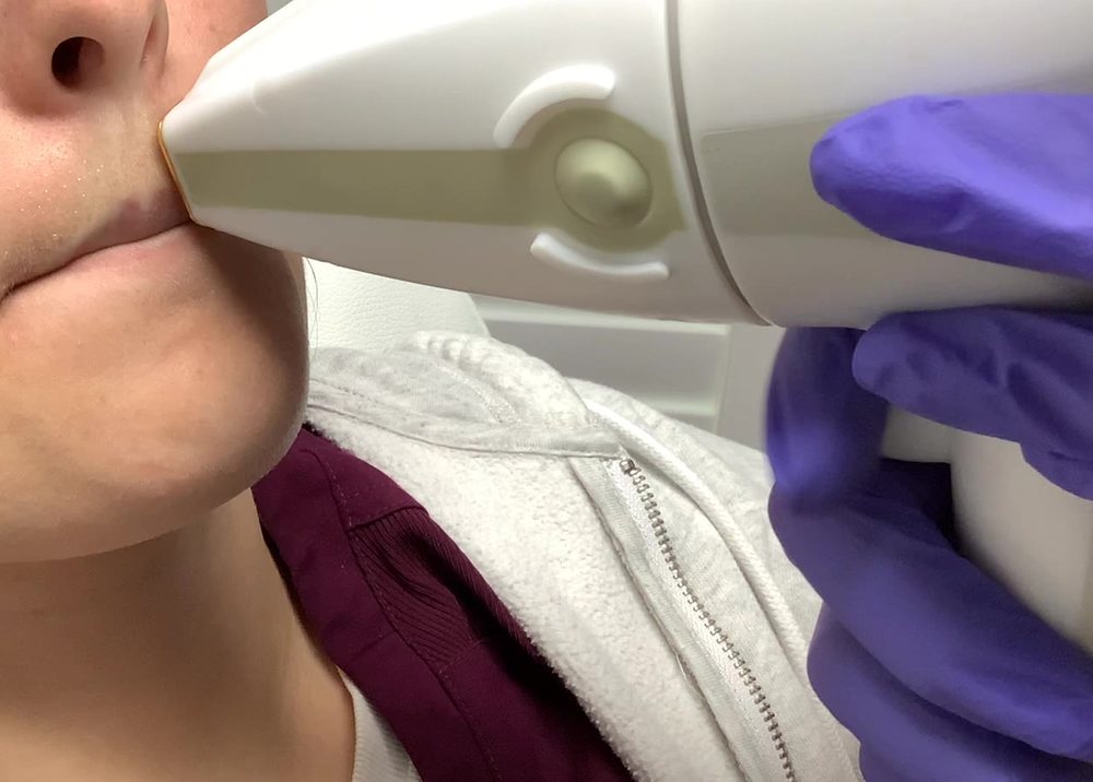A gloved provider performing Vectus laser hair removal on the upper lip in the Hilo office